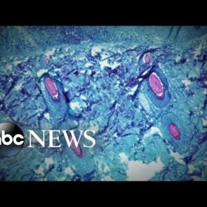 CDC officials investigate 5 presumptive monkeypox cases in US