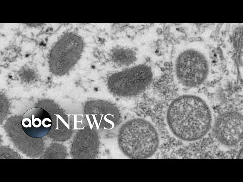 Monkeypox outbreak grows
