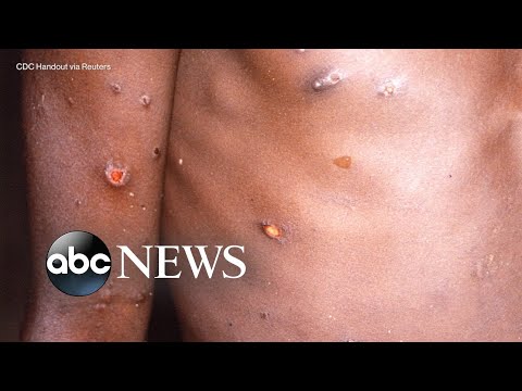 The symptoms, treatment for monkeypox