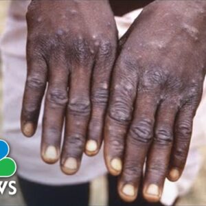 What You Need To Know About The Monkeypox Virus