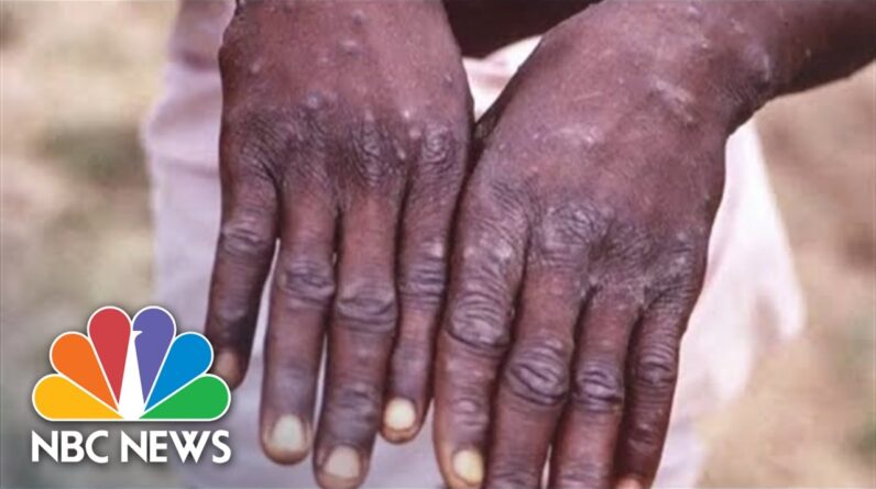 WHO Warns Monkeypox Must Be Contained Before It Becomes Global Issue